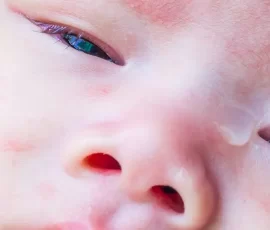 0 Bebeklerde Konjonktivit (Pembe Göz) Nedir Belirtileri Nelerdir (1) (1)
